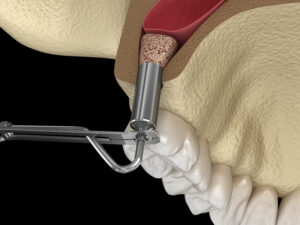 Sinus Lift Procedure