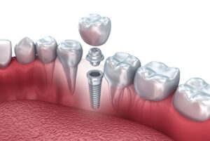 Mini Dental Implants in Costa Rica