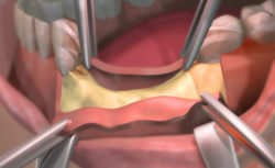 Bone Graft for Dental Implants