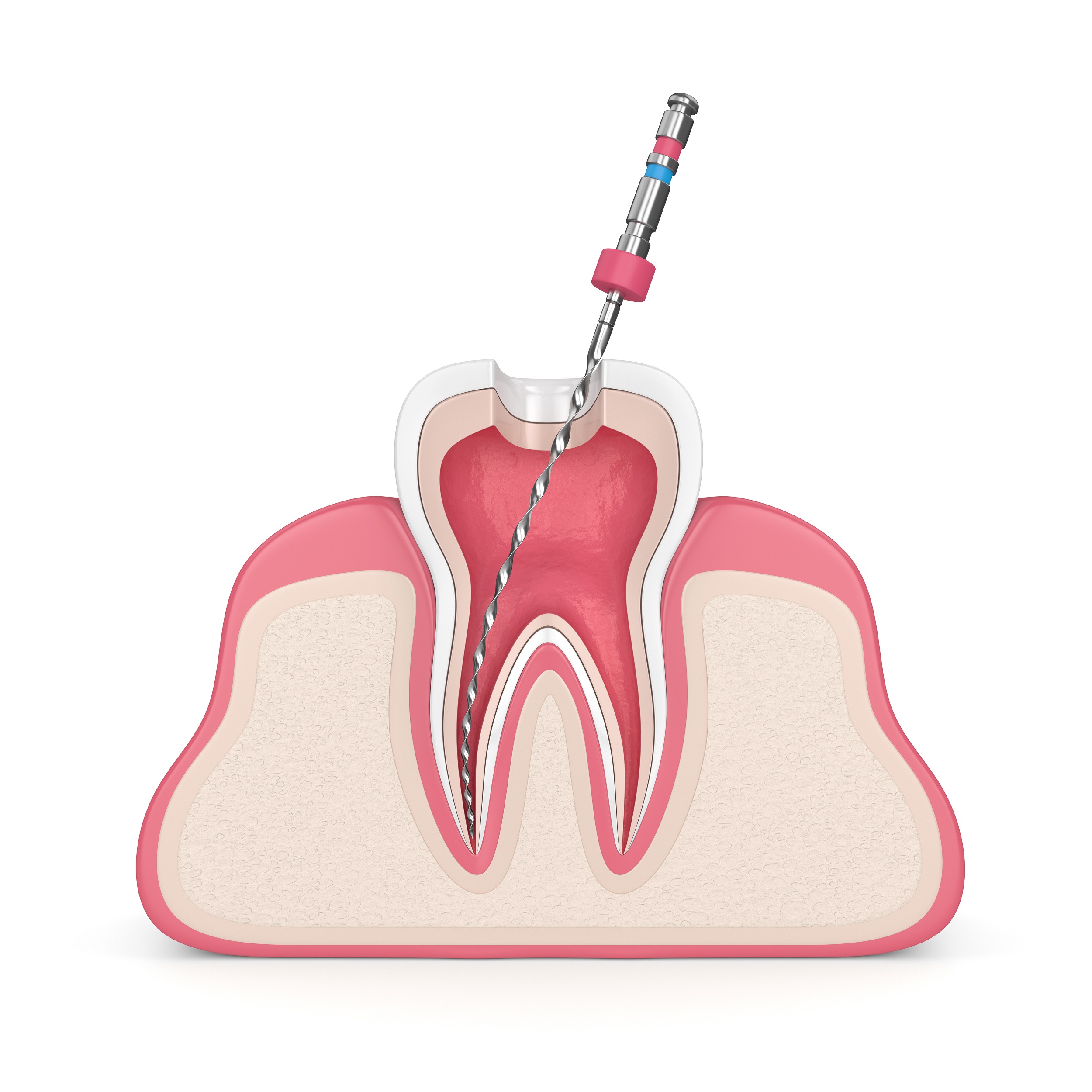 Root Canal Therapy – Maple Ridge Endodontics