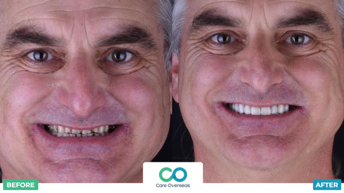 Before and after image of dental implants in Costa Rica patient Tim Guidotti